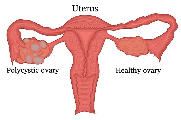 polycystic-ovary-syndrome